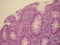 Amibik Kolit Teşhis ve Tedavisi