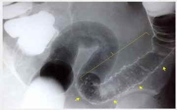 İskemik Kolit Belirtileri ve Tedavisi