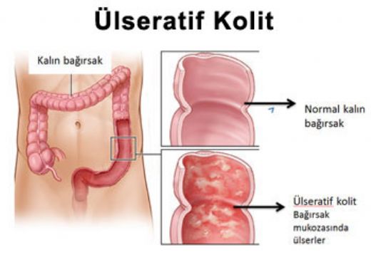 Kolit Hastal