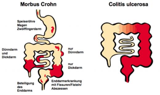 Ülseratif Kolit Ve Crohn Hastalığı