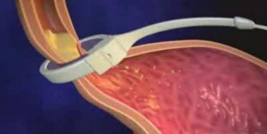 Gastroenterit Ve Kolit